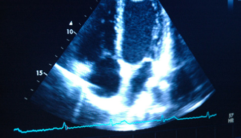 Echocardiogram image of the heart