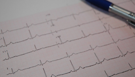 Arrhythmia monitor